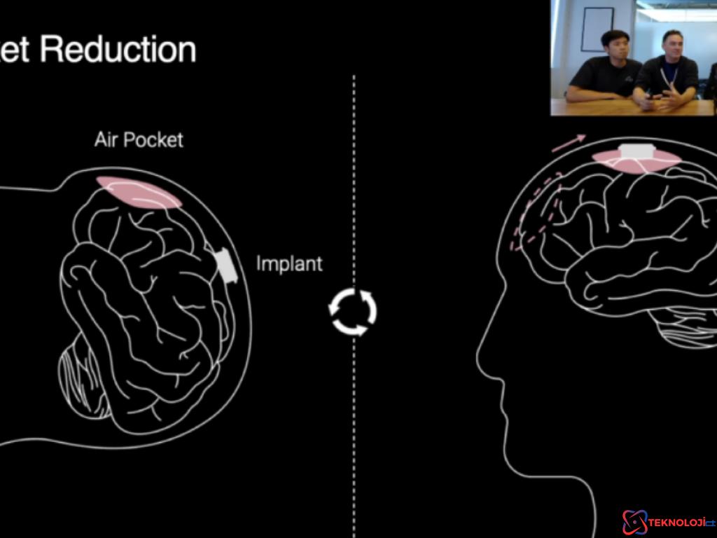 Neuralink İkinci İnsan Hastası Ameliyatı